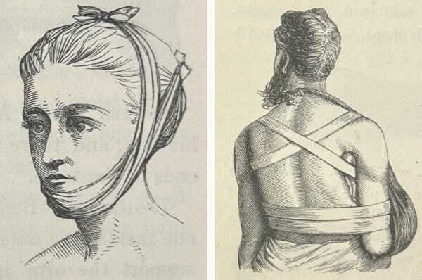 Drawings from the Guide, showing bandaging for a broken jaw (page 15) and a broken collar bone (p16).